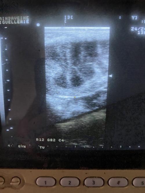 Normal uterus of a mare in early oestrus